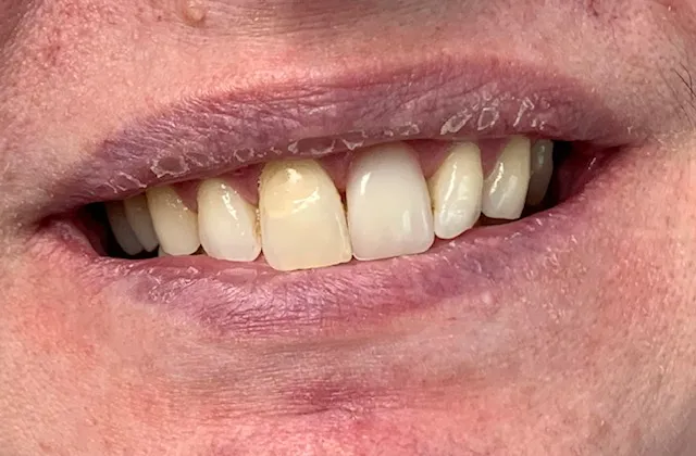 Replace-missing-teeth-af
