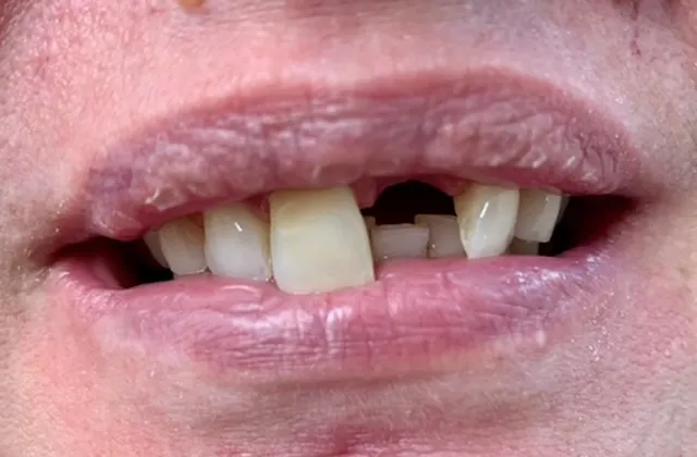 Replace-missing-teeth-bf